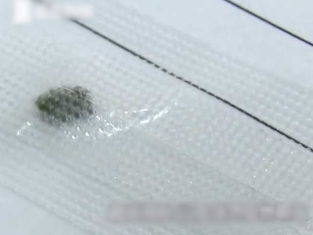 醫生為豆豆進行眼球清創縫合並取出異物。 網圖