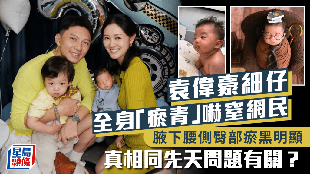 袁偉豪細仔全身「瘀青」嚇窒網民  腋下腰側臀部瘀黑明顯  真相同先天問題有關？