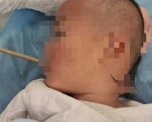 男童喉嚨被筷子貫穿。網上圖片