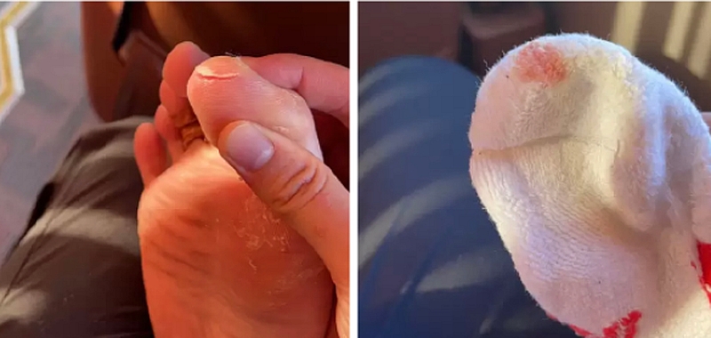 陳雨菲右腳大腳趾受傷流血。網圖