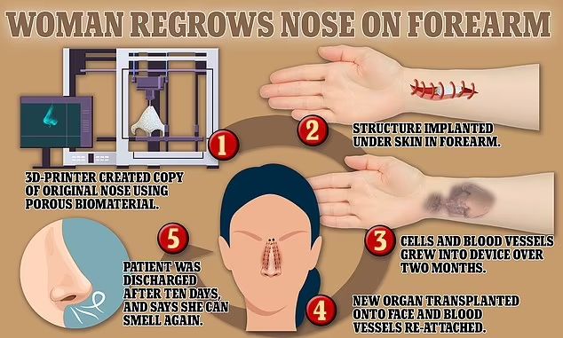鼻子移植的图解。