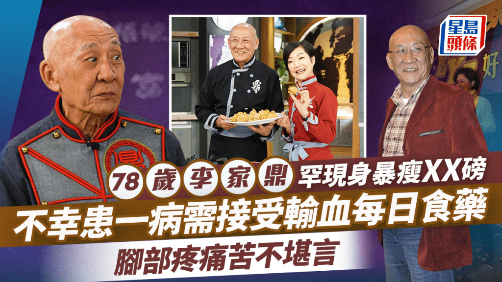 78歲李家鼎罕現身暴瘦XX磅  不幸患一病需接受輸血每日食藥  腳部疼痛苦不堪言  