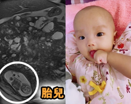 台灣一名孕媽子宮長巨型肌瘤塞滿全腹,更曾懷疑是惡性腫瘤,但她堅持捱至35週剖腹產,幸母子平安。(網圖)