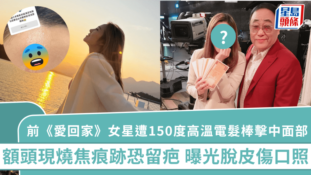 前《愛回家》女星遭150度高溫電髮棒擊中面部 額頭現燒焦痕跡恐留疤 曝光脫皮傷口照
