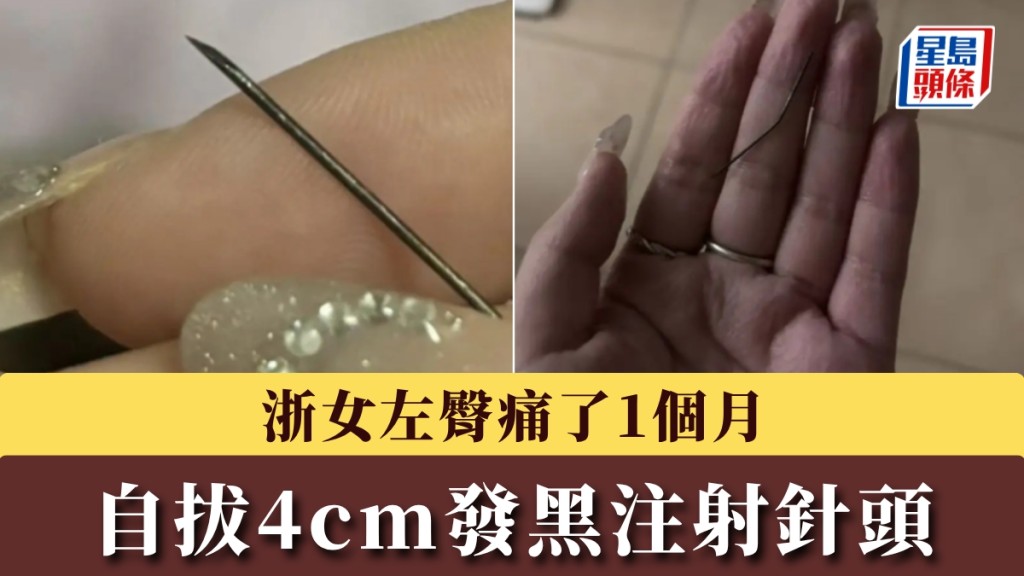 浙女左臀劇痛1個月，自拔4cm生鏽發黑針頭，疑因騎共享單車出事。