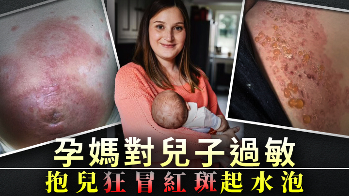 孕媽狂冒紅斑起水泡抱兒痛苦難耐,醫生指她對兒子過敏。網圖