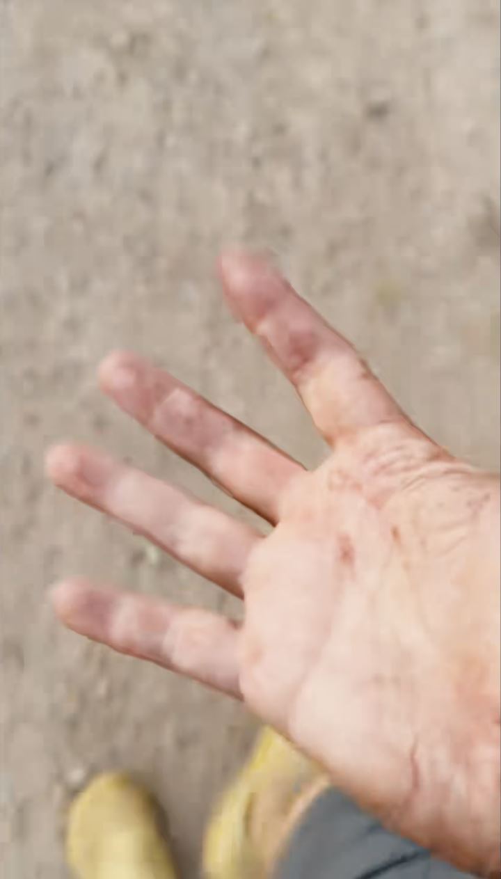 杨雷由缅甸诈骗园逃亡时手脚受伤。