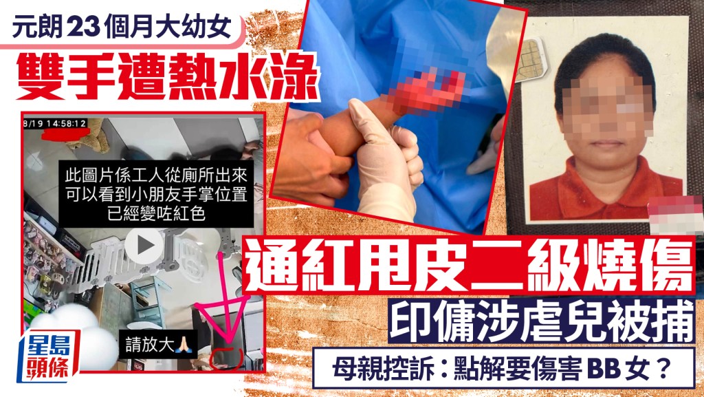 元朗23個月大女嬰雙手二級燒傷 母親控訴：點解要傷害BB女 印傭涉虐兒被捕