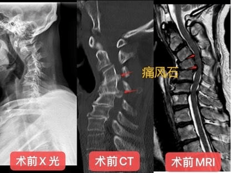 梁叔手術前的技掃瞄照。