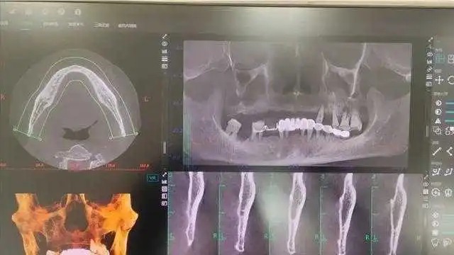 老李被口腔醫院過度醫療,一次過拔光全口12顆牙齒。 老李被口腔醫院過度醫療,一次過拔光全口12顆牙齒。