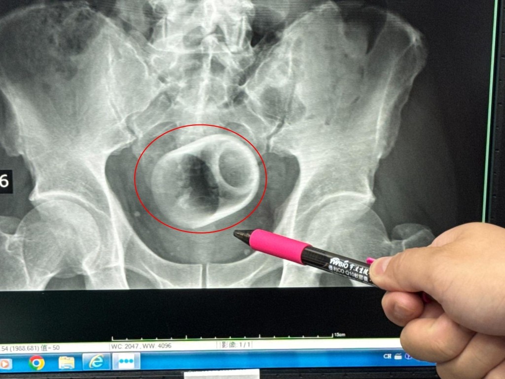 台男將陶瓷杯塞進肛門，手術後才取出。李綜合醫院