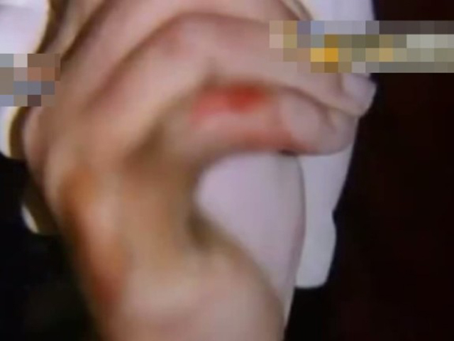 女孩的手指部分皮肤剥落。 网图）