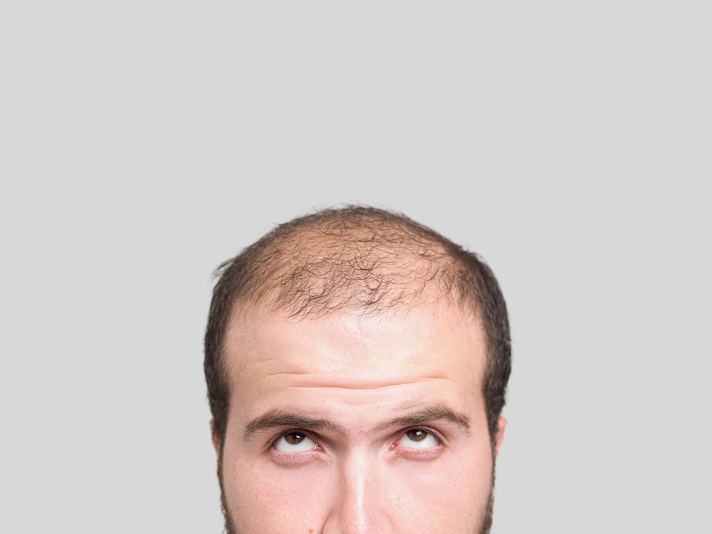 印度禿頭男為「脫單」植髮，術後竟引發過敏反應慘亡。