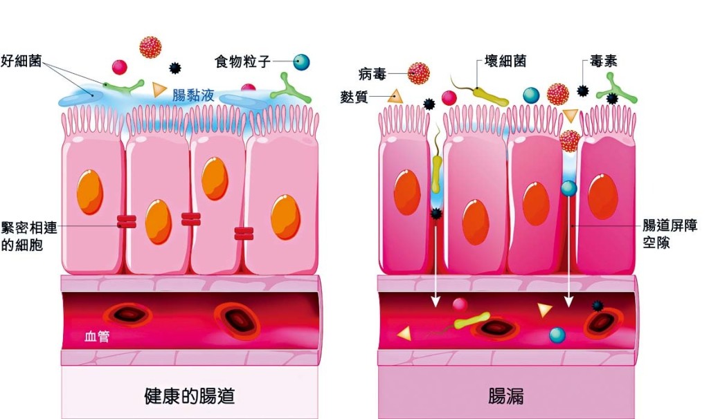健康腸道細胞本應緊密相連,一旦腸漏,腸腔內的細菌和毒素就會長驅直入血管。 健康腸道細胞本應緊密相連,一旦腸漏,腸腔內的細菌和毒素就會長驅直入血管。