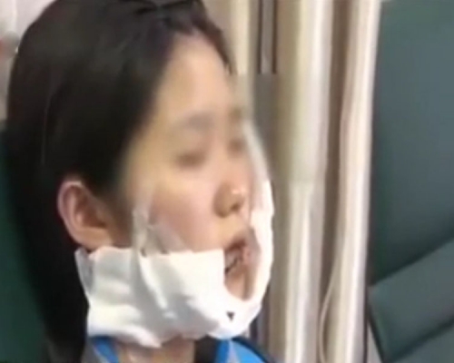 小楊被孫男用刀割臉,傷口縫了70多針。(網圖)