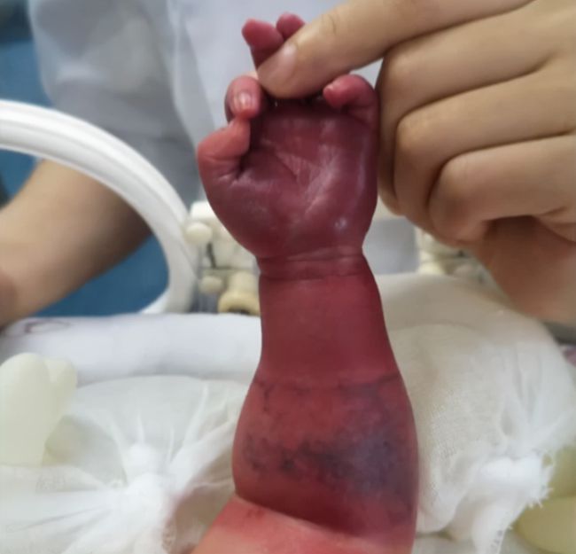嬰兒左臂又腫又黑，幸好及時送院就醫。 （網上圖片）