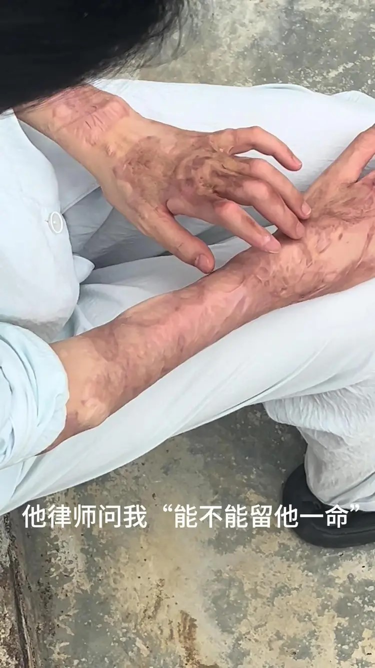 小兰被韦东传毁容及伤至双手失去生活能力。