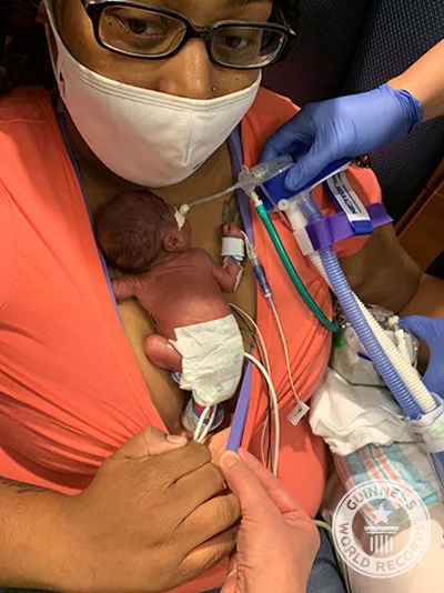 Curtis生下来时只有420克重、比1台iPad还要轻。