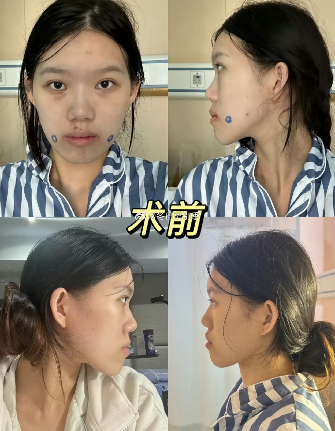 小雨术后状态。