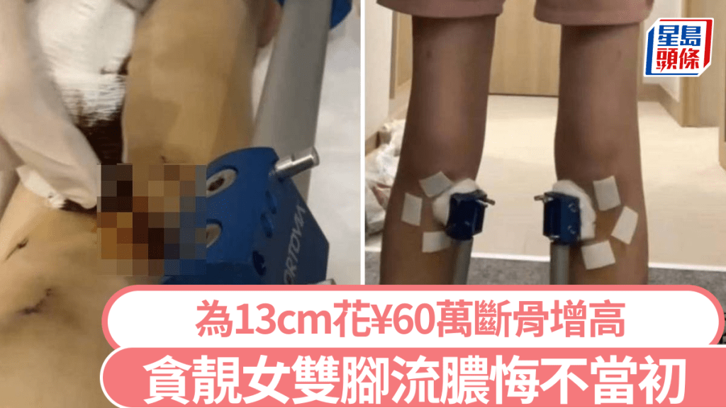 小夢接受增高術後出現併發症。紫牛新聞