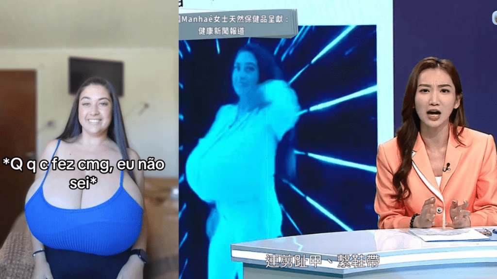 健康新聞報道|女子胸部持續變大乳房增至12公斤重 患一病苦不堪言 手術後胸部失知覺