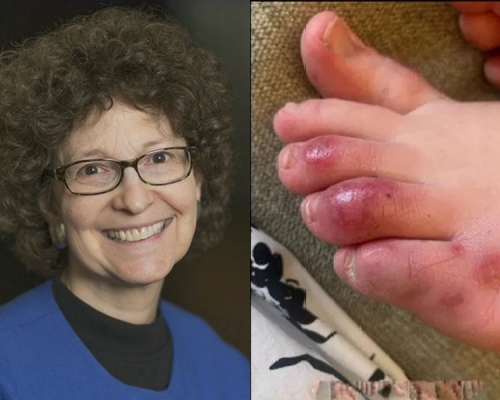 美国儿童皮肤科权威Amy Paller博士近日指出，脚趾出水痘或红肿块可能是无症状新冠病毒儿童患者的感染迹象。(网图)