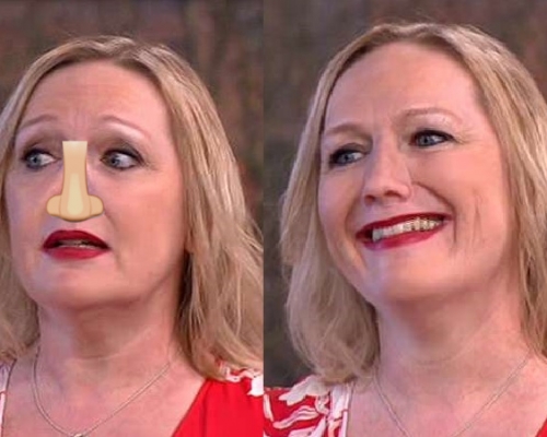 哈德曼出席直播節目，細說患病經歷期間，突然脫下義鼻。