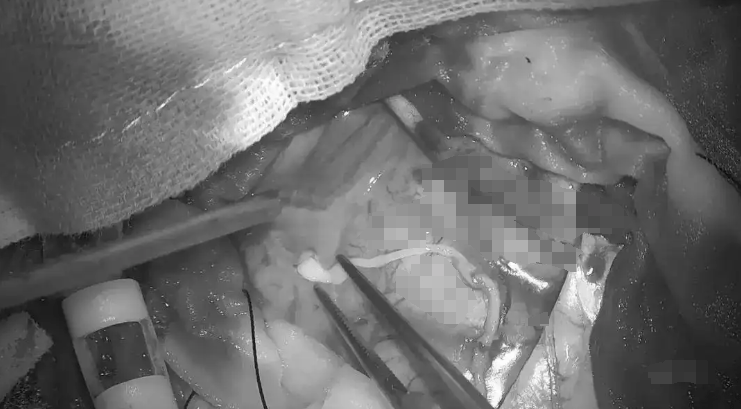 37歲男腦內藏10cm活蟲。羊城晚報 37歲男腦內藏10cm活蟲。羊城晚報