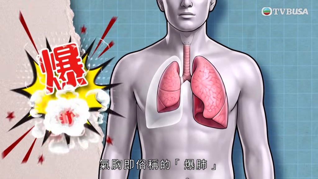 在二十出头尚就读医科期间,左胸突如其来的剧痛被诊断为俗称“爆肺”的气胸。 在二十出头尚就读医科期间,左胸突如其来的剧痛被诊断为俗称“爆肺”的气胸。
