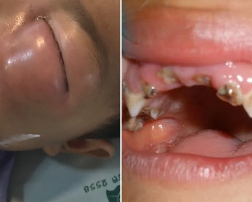 蛀牙導致的細菌感染後果可大可小。(網圖)