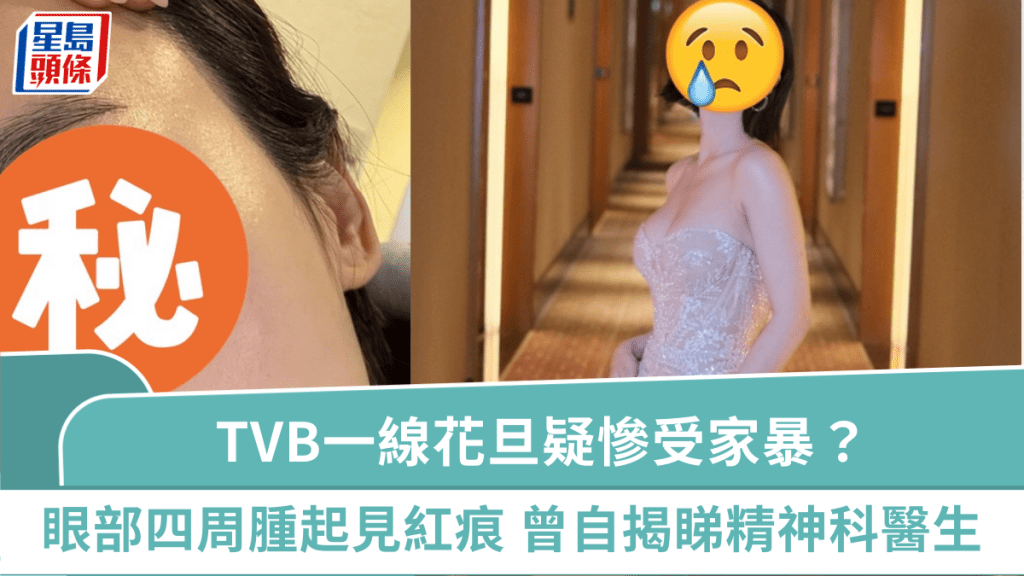 TVB一線花旦疑慘受家暴?眼部四周腫起見紅痕 曾自揭患驚恐症要睇精神科醫生