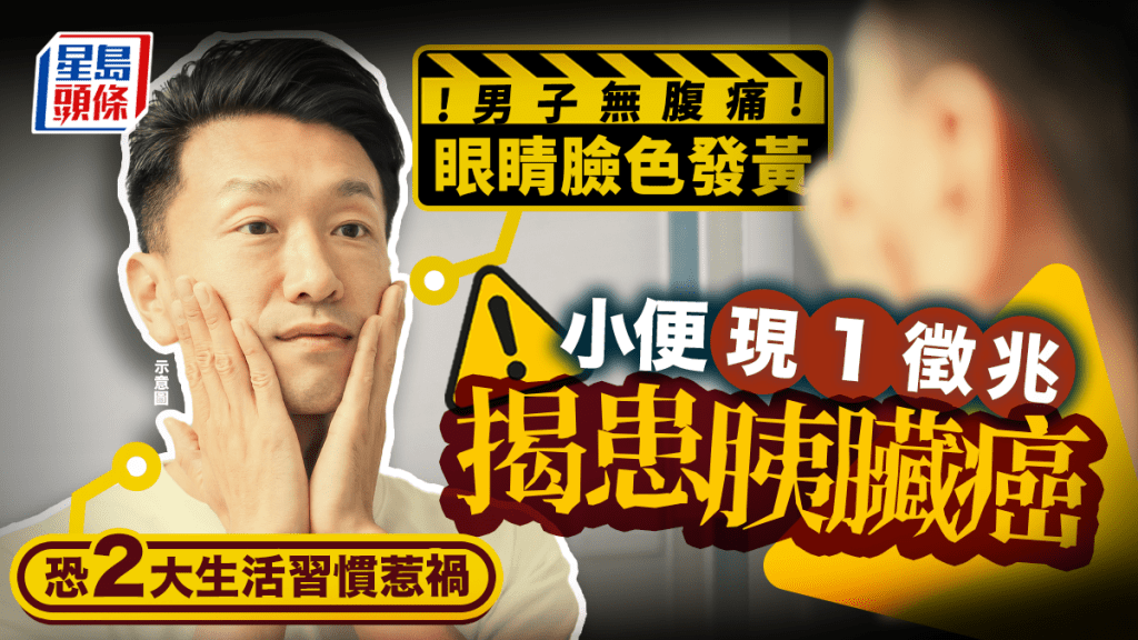 男子眼睛臉色發黃 小便現1徵兆揭患胰臟癌 恐2大生活習慣惹禍