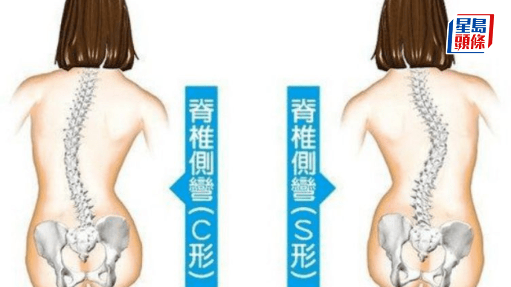 C型和S型脊柱側彎。圖片由筆者提供
