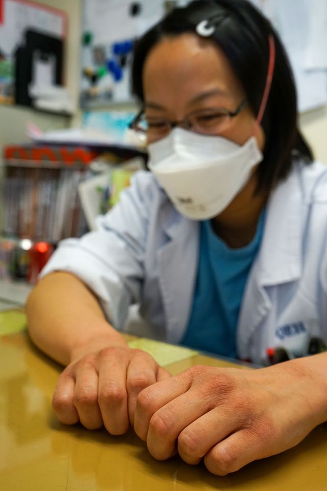 陳淑櫻回首過去抗疫的經歷和點滴,指高峰期一天要處理逾10宗確診個案,每日要洗手逾40次,令雙手紅腫損傷。 伊院通-QEH員工資訊台FB