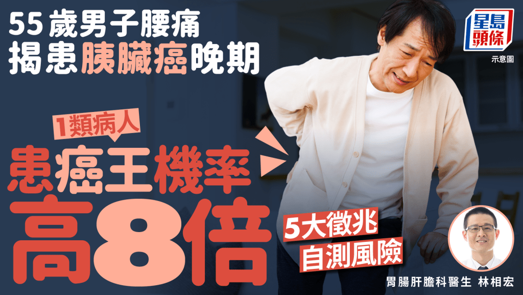 55歲男子腰痛揭患胰臟癌晚期 1類病人患癌王機率高8倍 醫生列5徵兆自測風險