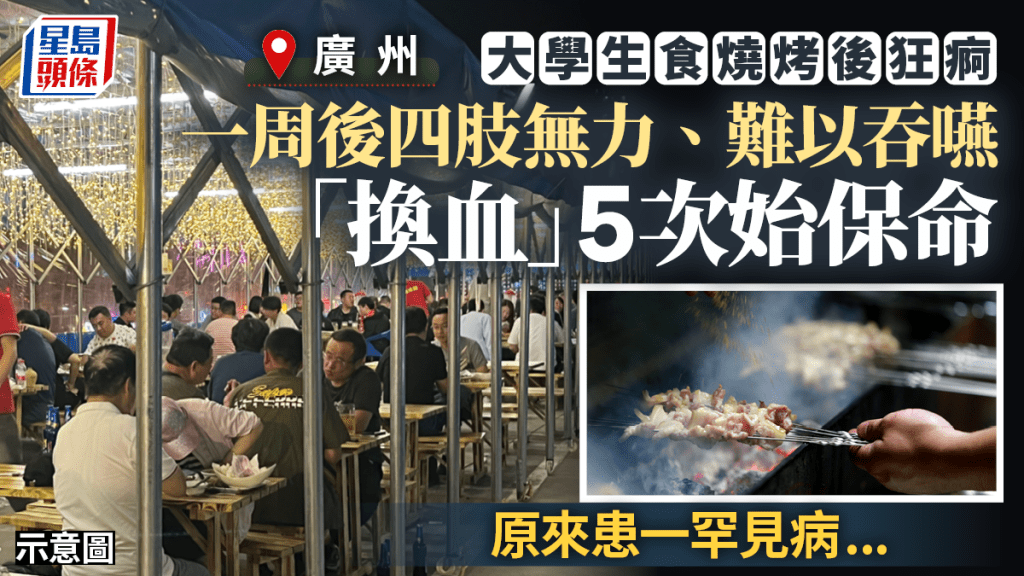 廣州有大學生因BBQ疑進食不潔食物，致患罕見免疫系統病，要「換血」5次才保命。