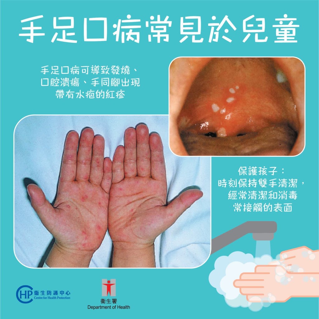 手足口病是香港極為常見的兒童傳染病。衞生防護中心 手足口病是香港極為常見的兒童傳染病。衞生防護中心