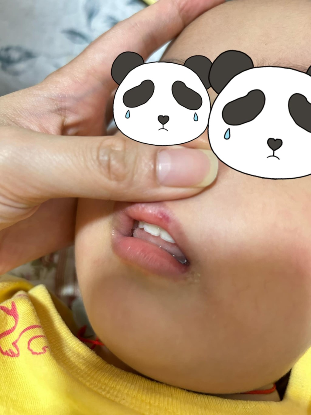疑被欺凌的小童嘴巴受傷。fb我長於大角咀重生版Ayla Wong圖片