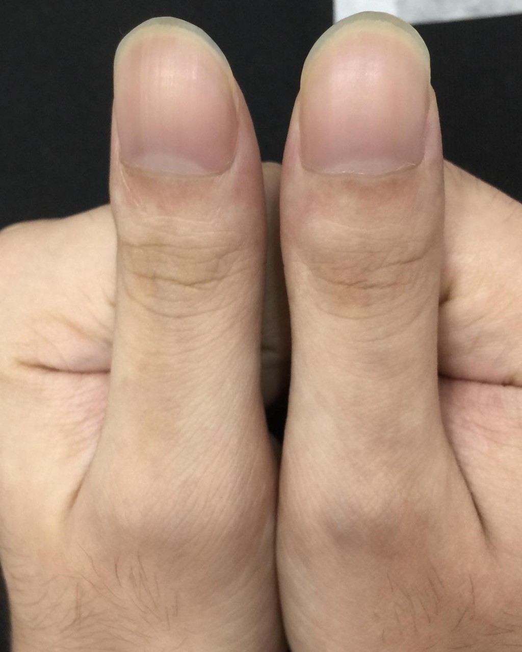 皮膚科醫生陳逸懃指，杵狀指呈現的特徵是「指甲弧度大於180°C，且指頭會變肥大」（圖片來源：陳逸懃醫生）