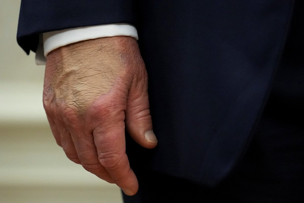 特朗普的右手背近期出現瘀青，引起傳媒關注。路透社