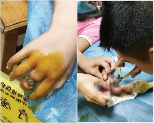 11歲女孩被戒指卡手近3個月,手指腐爛露骨。網圖