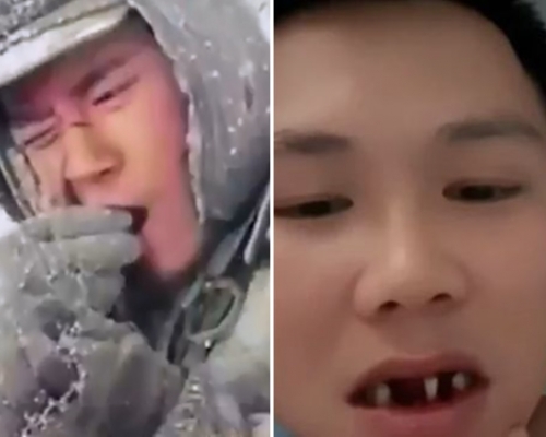 江西男子模仿《長津湖》情節(左)硬啃冷凍薯仔,結果導致3隻牙齒移位,須要拔除(右)。影片截圖