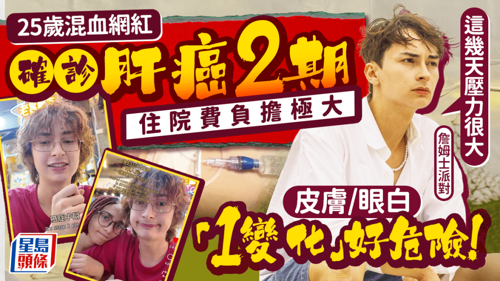 25岁混血网红「詹姆士派对」确诊肝癌2期 住院费负担巨大 一文睇清肝癌症状