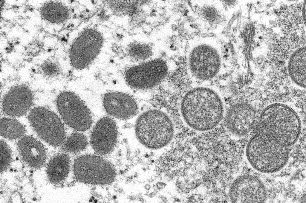 猴痘病毒。AP圖片