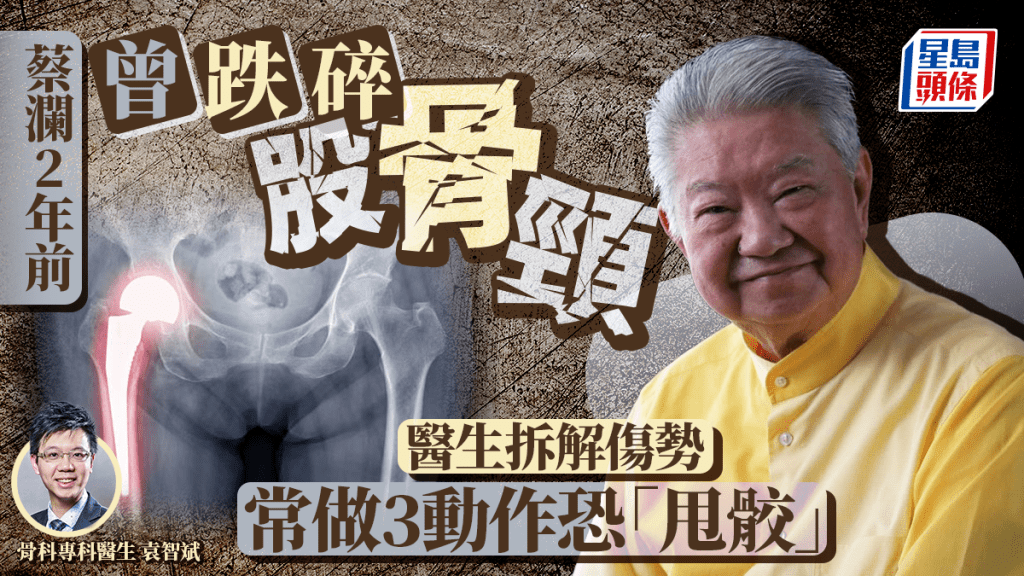 蔡瀾2年前曾跌碎股骨頸 醫生拆解傷勢 常做3動作恐「甩骹」