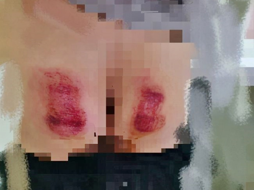 有學童被打到皮開肉綻。網圖