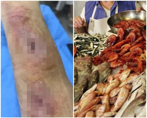 男子感染罕見惡菌「海魚分支桿菌」。網圖