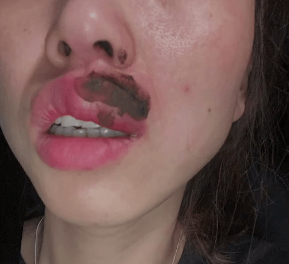 女子指被咬后，嘴巴马上就麻痹了失去感觉，同时伴随著胸闷的情况。