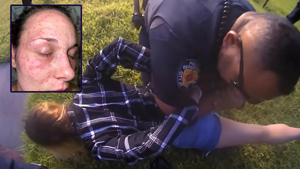 被警察按壓草地,美國女子臉部被紅火蟻嚴重咬傷。