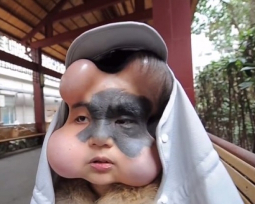 医生在肖艳的面部皮肤下植入4个扩张器，并注入生理盐水。 网上图片